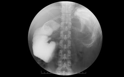 Case report: Intra-abdominal aggressive fibromatosis: A rare cause of hyperemesis